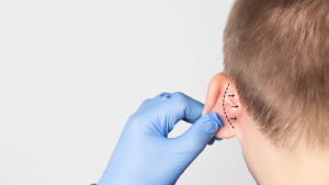 Costo otoplastica a Torino